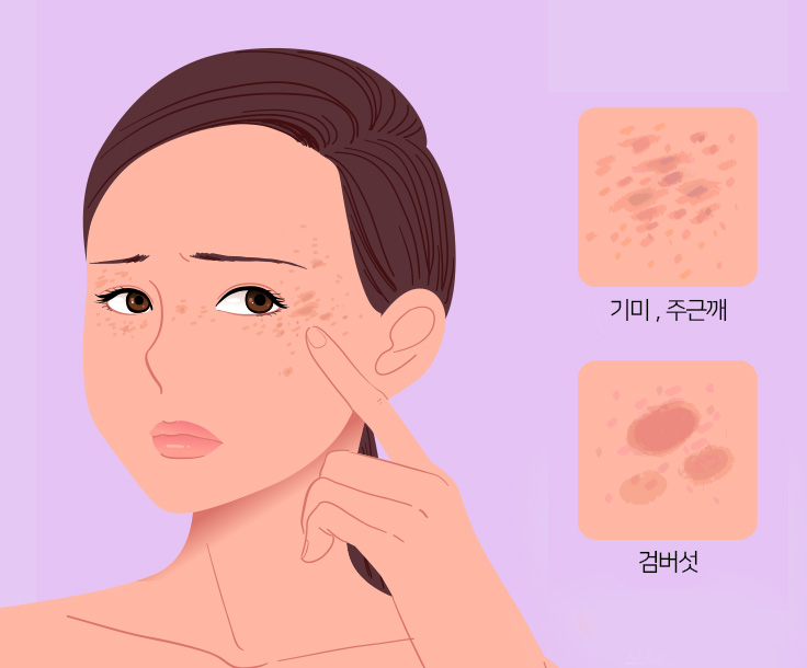 레이저 토닝