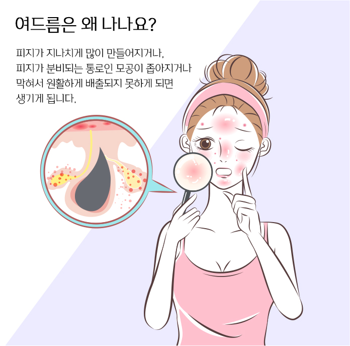 여드름
